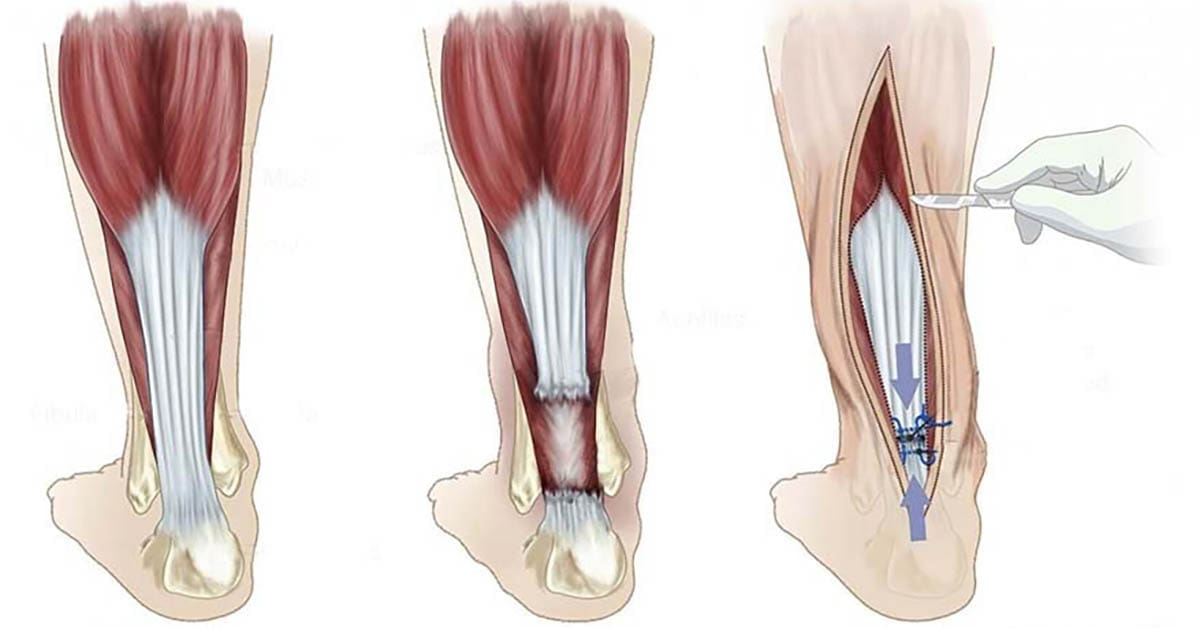Hrozí-vám-prasknutí-Achillovy-šlachy